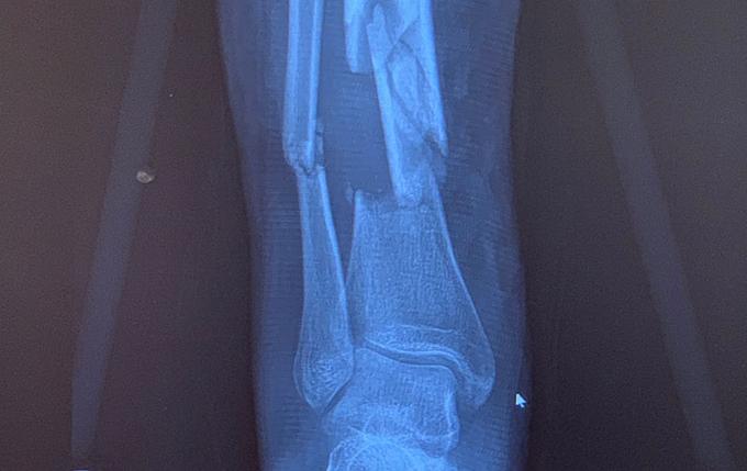xray showing bone fractures in the leg